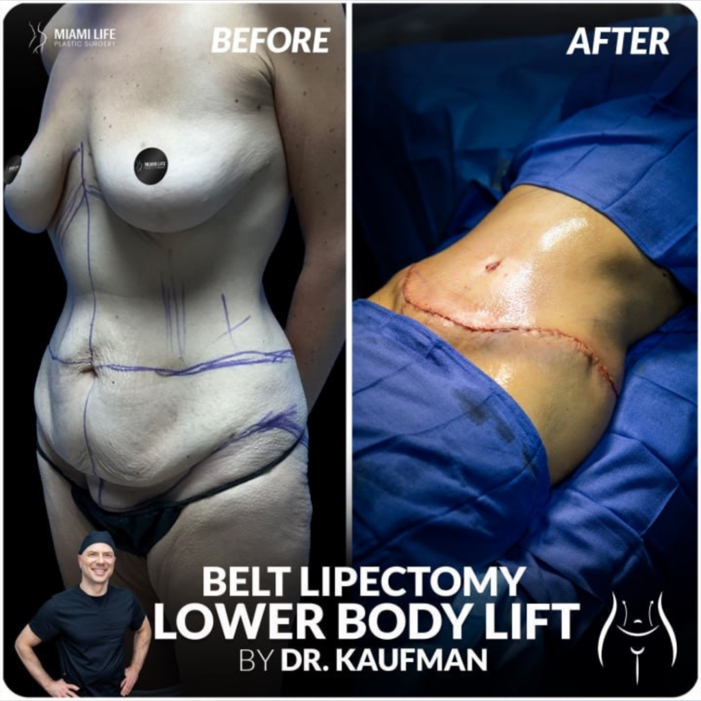 Belt Lipectomy, After Weightloss Skin removal Surgery, Lower Body Lift