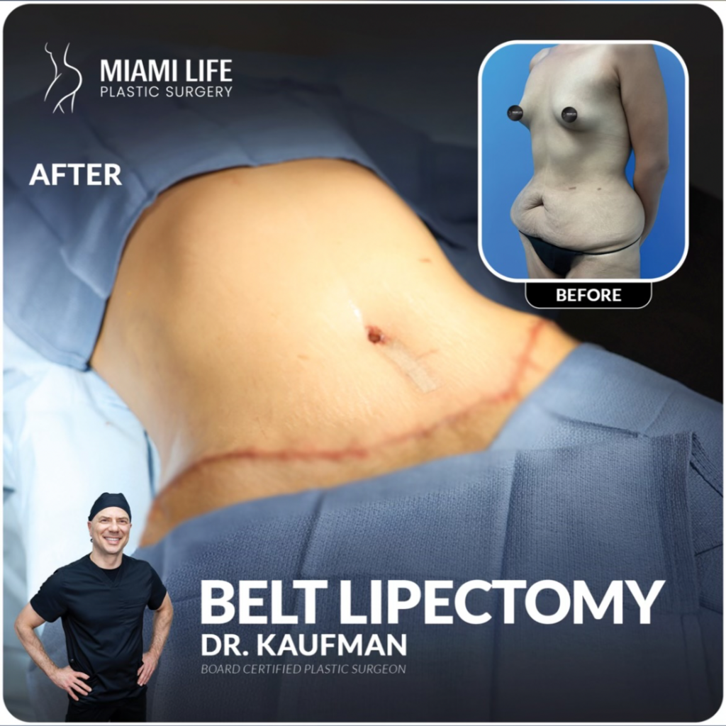 Belt Lipectomy, After Weightloss Skin removal Surgery, Lower Body Lift