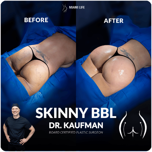 skinny BBL by Dr.Kaufman at Miami Life Plastic Surgery