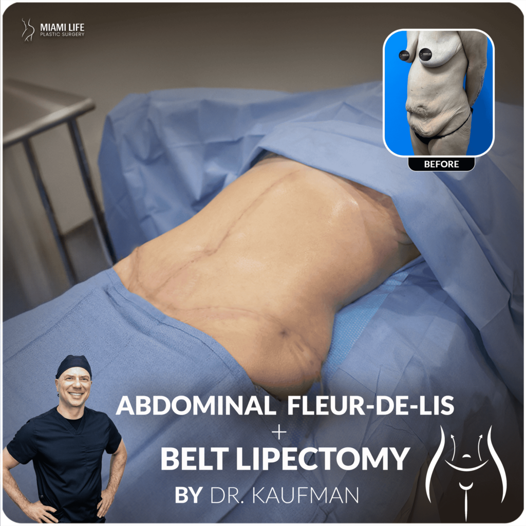 Abdo FDL + Belt Lipec Dr. Kaufman 1.03.24