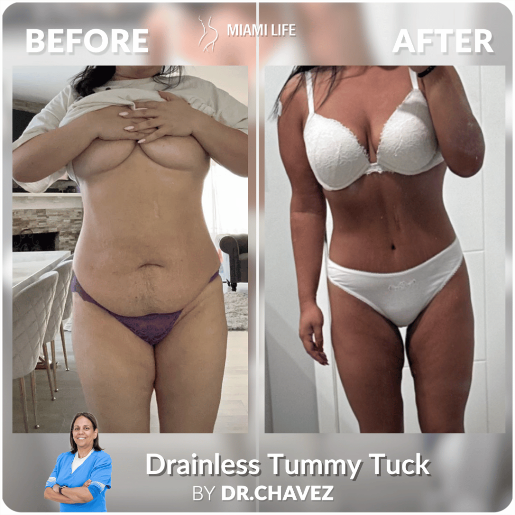 Drainless Tummy Tuck