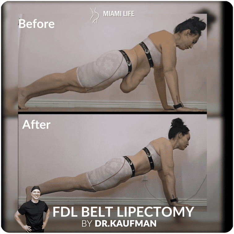 FDL BELT LIPECTOMY