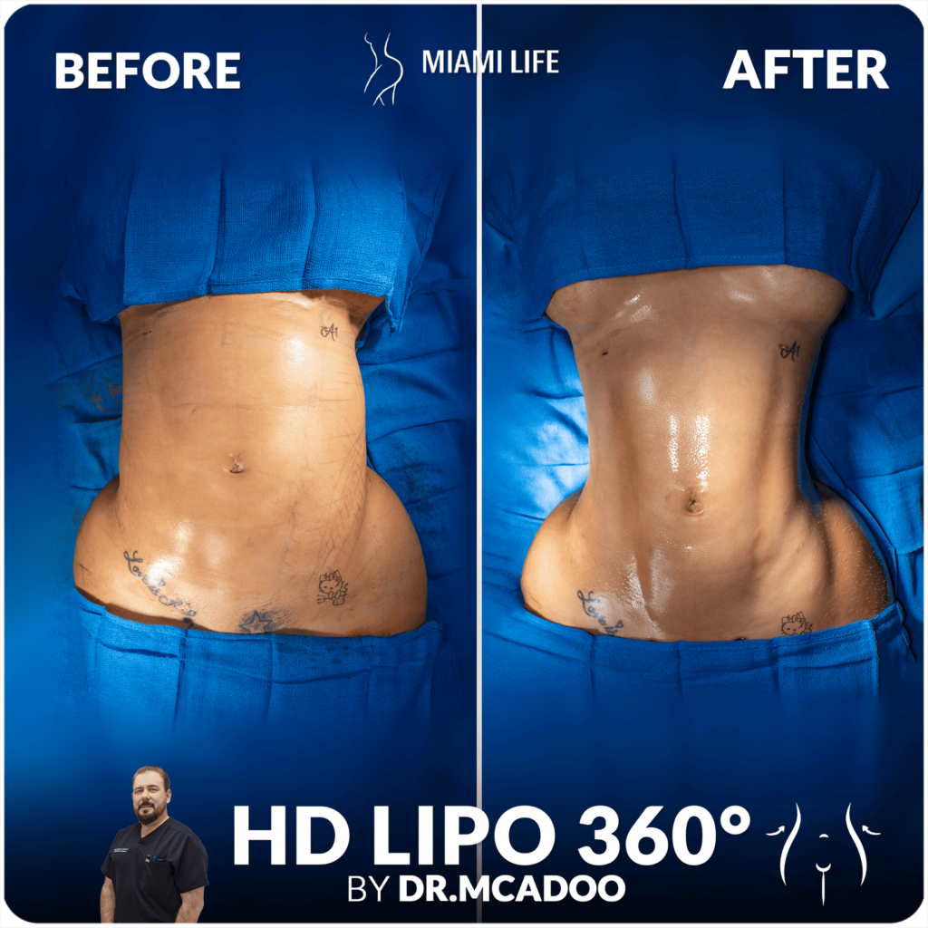 HD LIPO Dr.McAdoo 05.24.2024