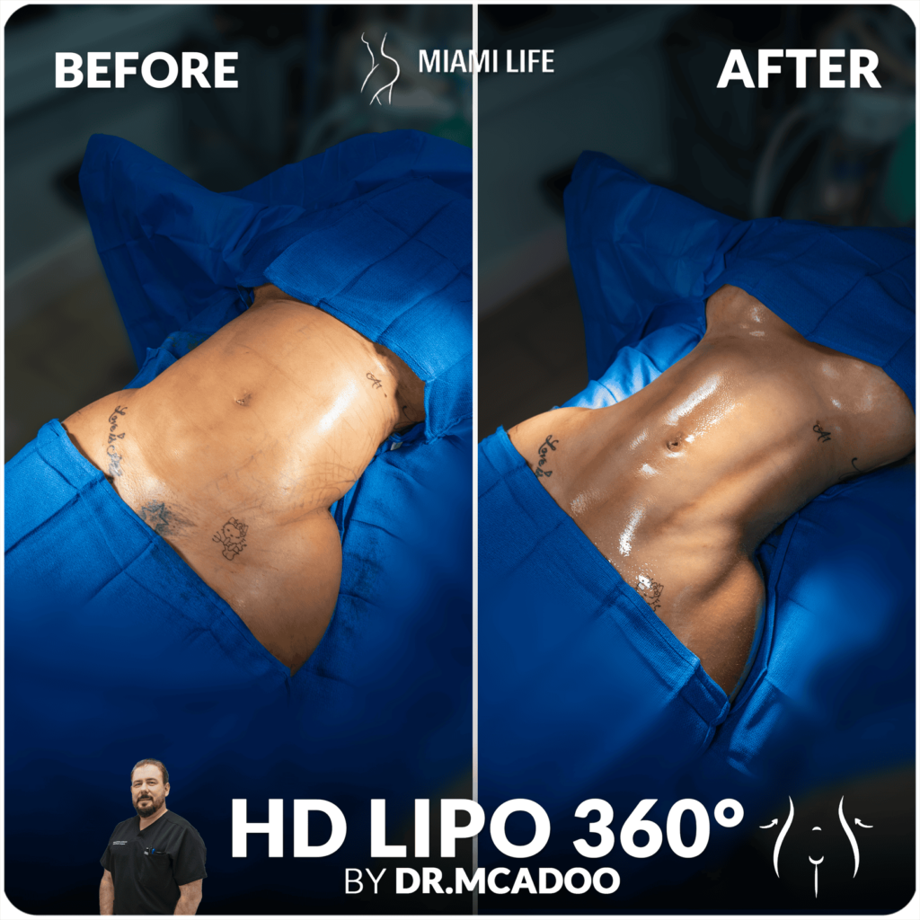 HD LIPO Dr.McAdoo 05.24.2024