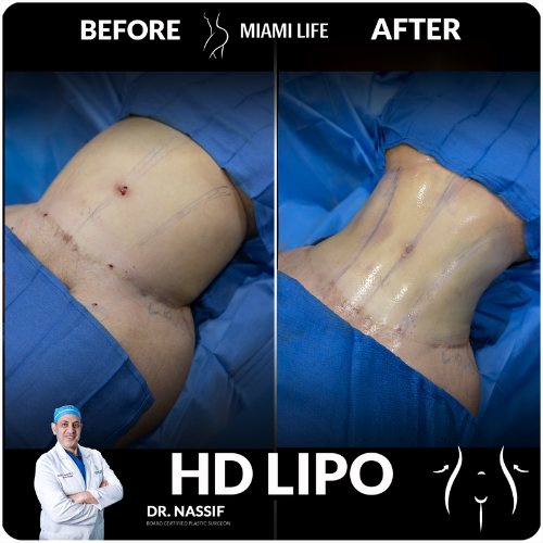 HD Lipo 360 - Dr.Nassif, Miami Life Plastic Srugery, before and after