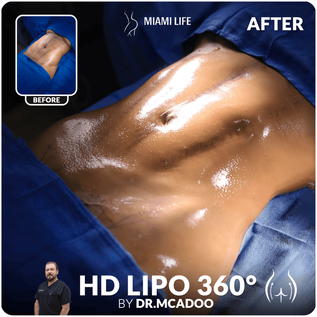 HD Lipo Dr.McAdoo 05.20.2024