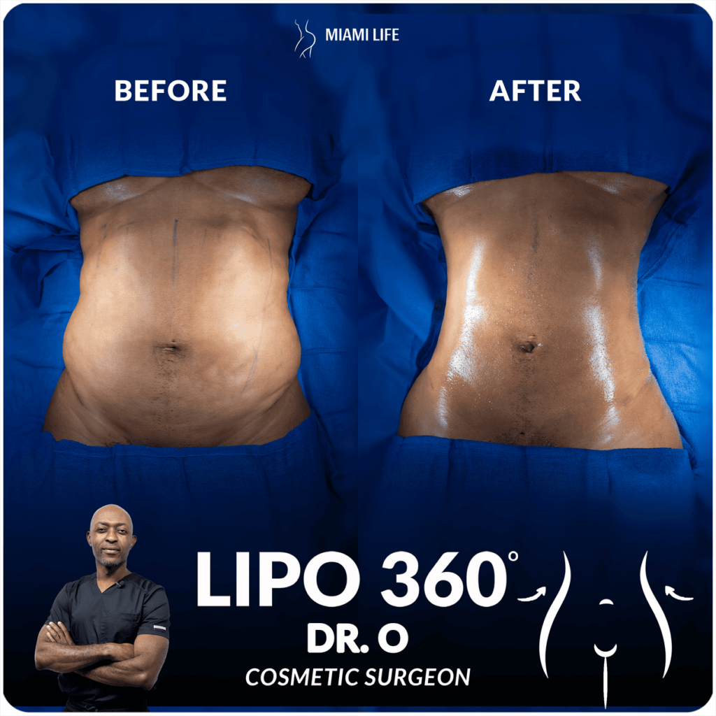 Lipo Dr. O 5.23.24