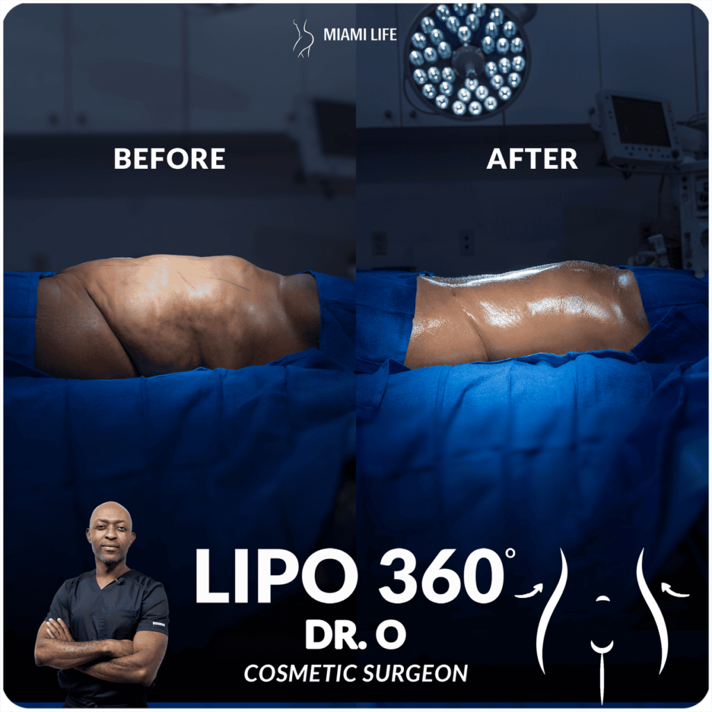 Lipo Dr. O 5.23.24 2