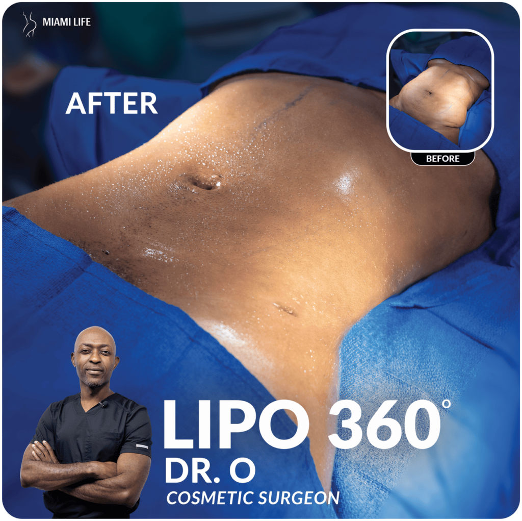 Lipo 360 – Miami Life Plastic Surgery