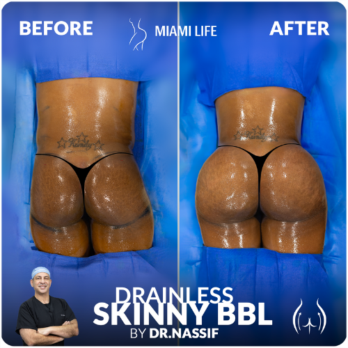 bbl-doctor-nassif-miami-life-plastic-surgery