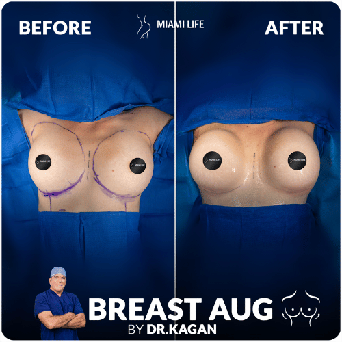 breast-aug,emtation-kagan-miami-life-plastic-surgery