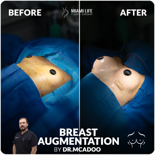 breast-aug,emtation-mcadoo-miami-life-plastic-surgery