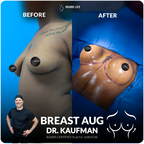 breast-augmentation-kaufman-miami-life-plastic-surgery