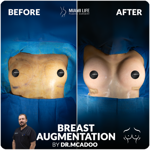 breast-augmentation-miami-life-plastic-surgery