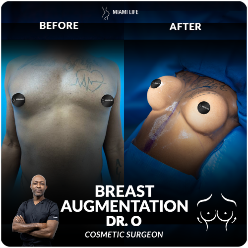 breast-augmentation-onyeka-miami-life-plastic-surgery