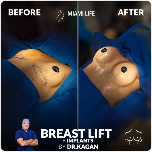 breast lift with silicone implants, breast surgery, dr kagan, board certified plastic surgeon