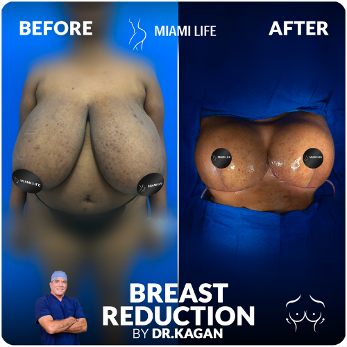 breast-reduction-doctor-kagan-miami-life-2