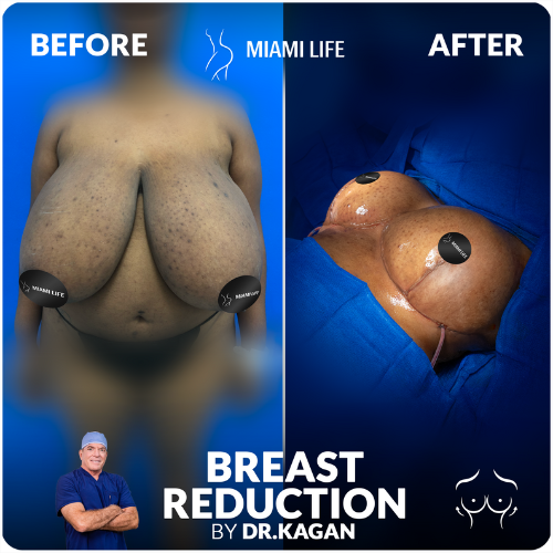 breast-reduction-doctor-kagan-miami-life-3