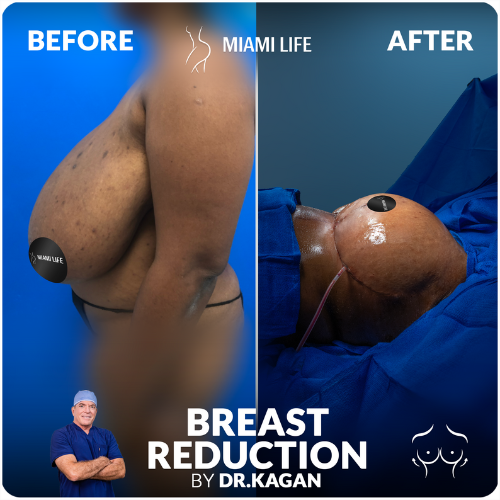 breast-reduction-doctor-kagan-miami-life