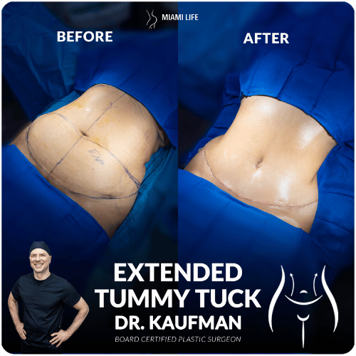 extended-tummy-tuck-kaufman-1