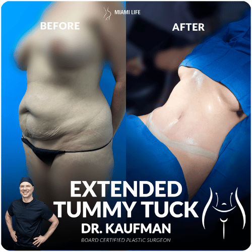 extended-tummy-tuck-kaufman-2