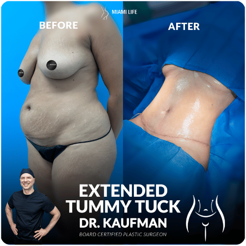 extended-tummy-tuck-kaufman-3