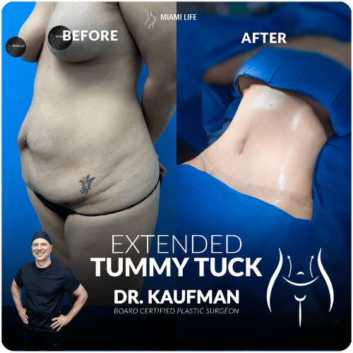 extended-tummy-tuck-kaufman-4