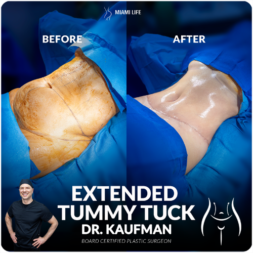 tummy tuck, extended tummy tuck, abdominoplasty, dr.kaufman, miami life plastic surgery