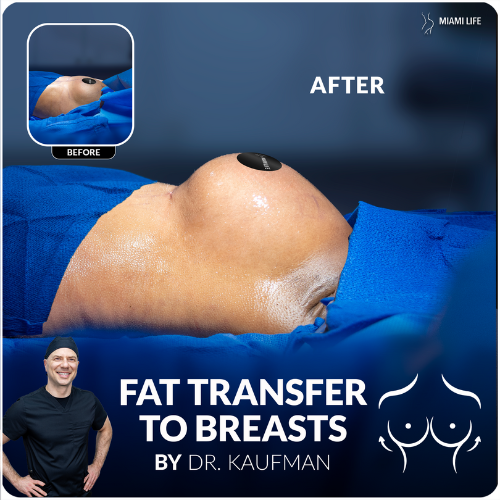 autologous fat graft to breasts, fat transfer to breasts, breast augmentation with fat, dr.kaufman, miami life plastic surgery,