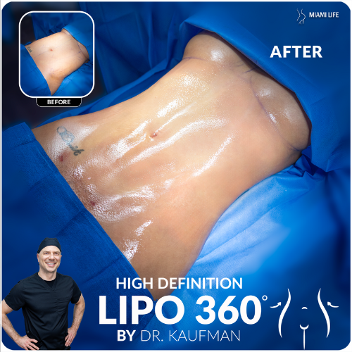 high-definition-lipo360-kaufman-miami-life-plastic-surgery-2