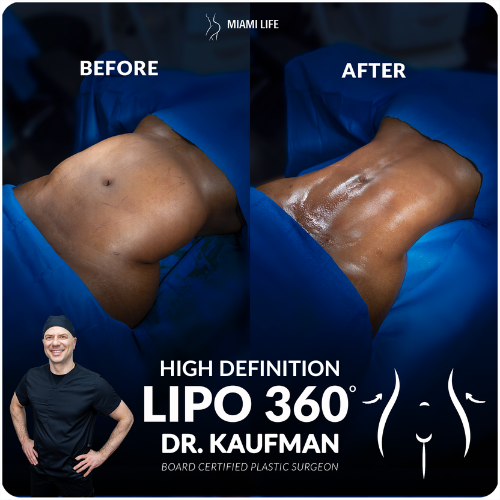 high-definition-lipo360-kaufman-miami-life-plastic-surgery