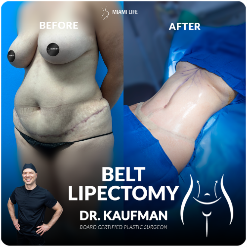 kaufman-belt-lipectomy-lower-body-lft-1