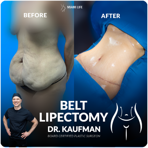 kaufman-belt-lipectomy-lower-body-lft-2