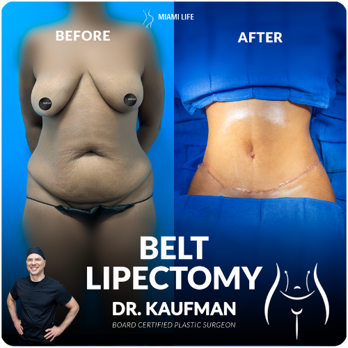 kaufman-belt-lipectomy-lower-body-lft-3