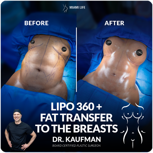 fat transfer to breasts, breast augmentation with fat, fat trasnfer to breasts with lipo 360