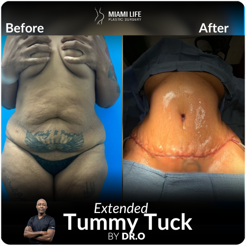 extended tummy tuck with lowline incision, miami life plastic surgery, dr.o, onyeka Nwokocha