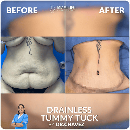 Best Tummy Tuck Austin Tx