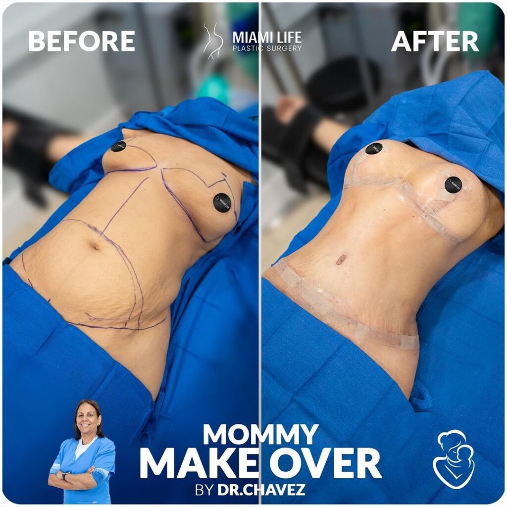 mommy makeover, drainless tummy tuck, breast lift, dr.chavez,