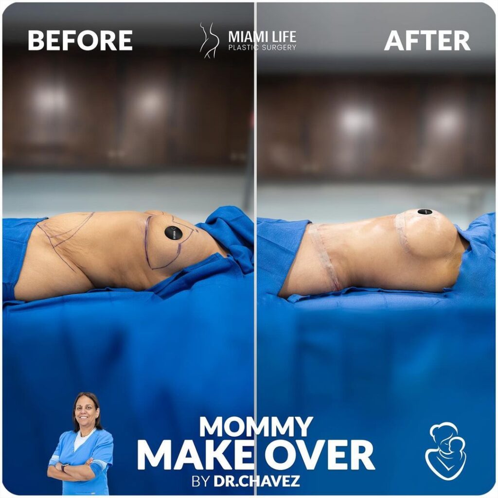 mommy makeover, drainless tummy tuck, breast lift, dr.chavez,