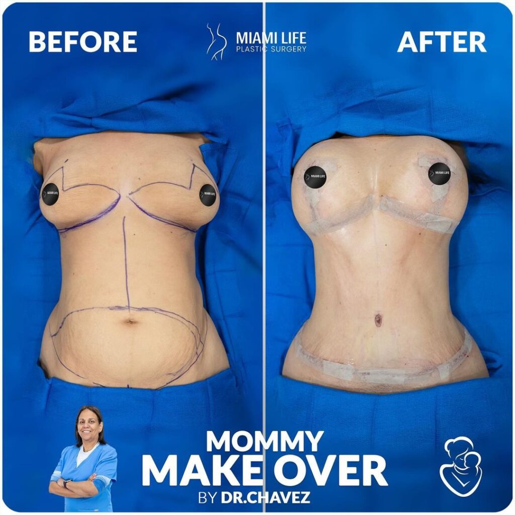 mommy makeover, drainless tummy tuck, breast lift, dr.chavez,