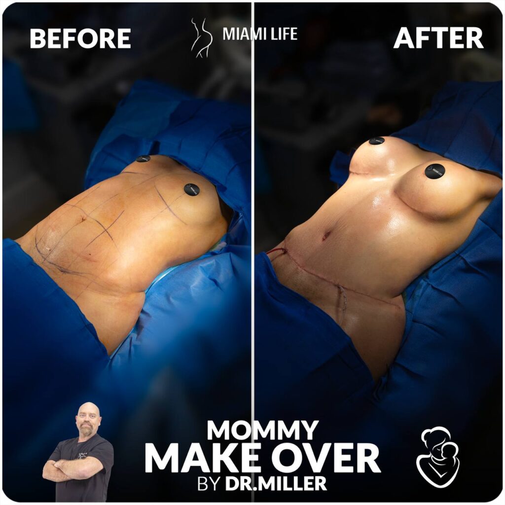 mommy makeover, dr.miller, miami life plastic surgery