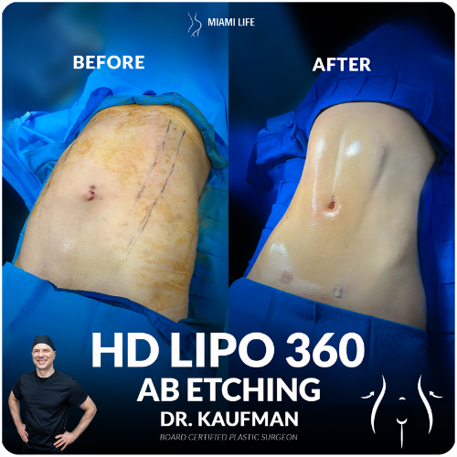 HD Lipo 360 - Dr.kaufman, Miami Life Plastic Srugery, before and after