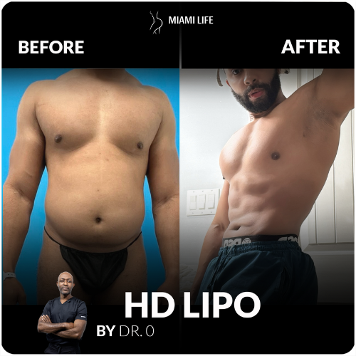 HD Lipo 360 - Dr.onyeka, Miami Life Plastic Srugery, before and after