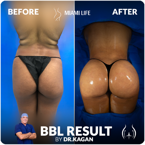 Brazilian butt lift natural results miami life plasticsurgery