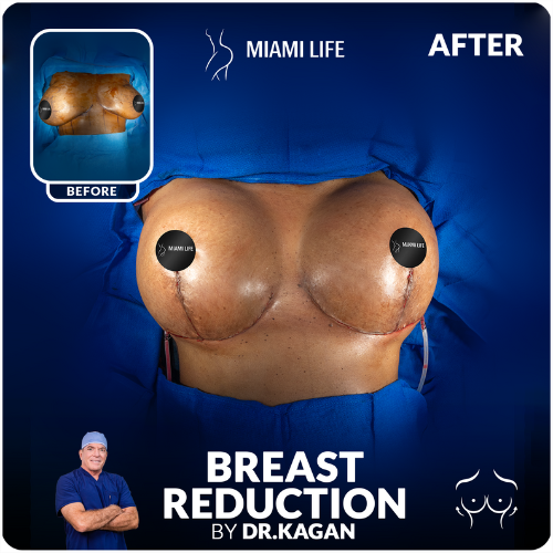 breast reduction, dr.kagan, Miami Life Plastic Srugery, before and after