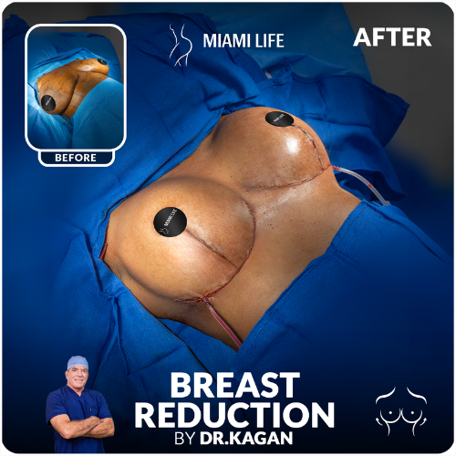 breast reduction, dr.kagan, Miami Life Plastic Srugery, before and after (1)