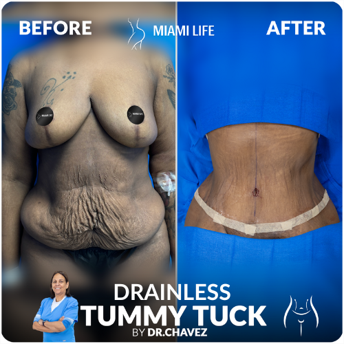 drainless-tummy-tuck-doctor-chavez-miami-life-plastic-surgery