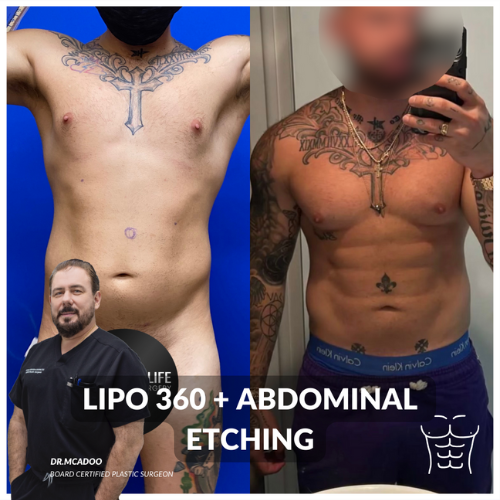 hd-lipo-360-mcadoo-2-miami-life-plastic-surgery