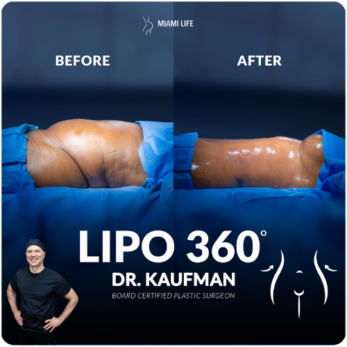 lipo-360-kaufman-2-miami-life-plastic-surgery