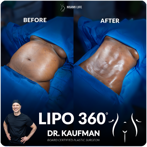 Lipo 360 – Miami Life Plastic Surgery